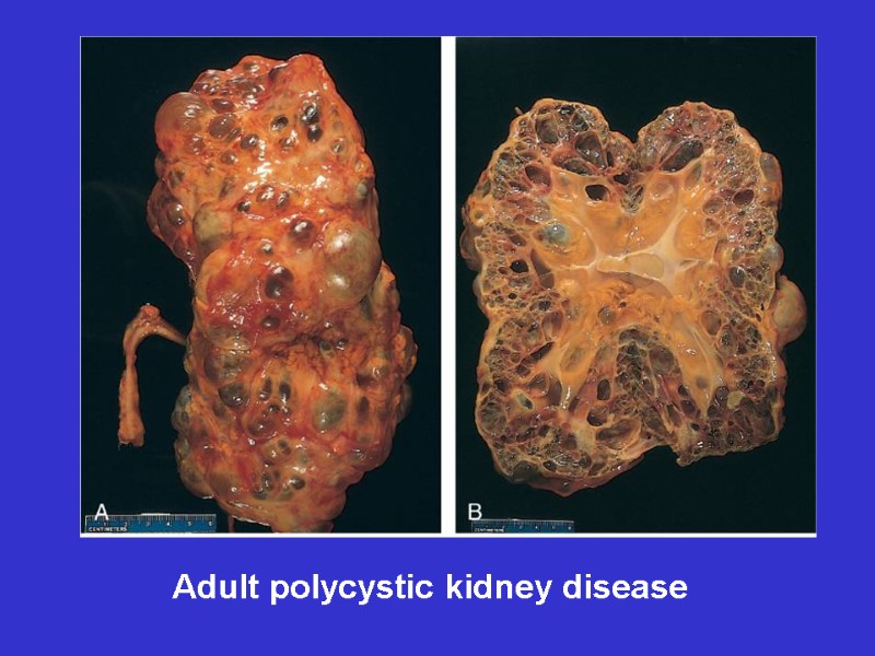 Adult polycystic kidney disease